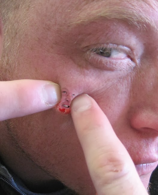 Cold Sores (Fever Blisters) Picture Image on MedicineNet.com